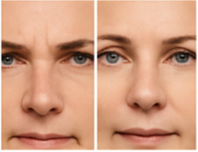 Before and after Botox treatment showcasting smoother skin.